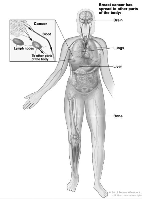 breast cancer stage 4